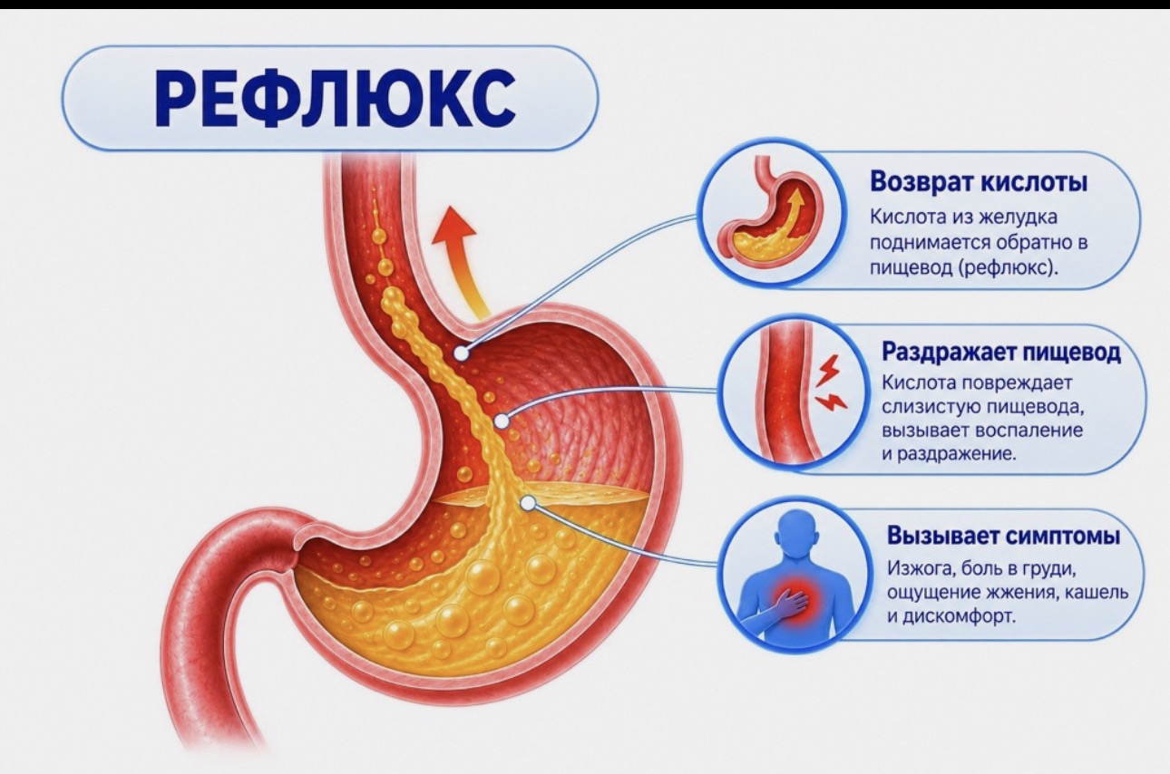 гастроэзофашеальный рефлюкс